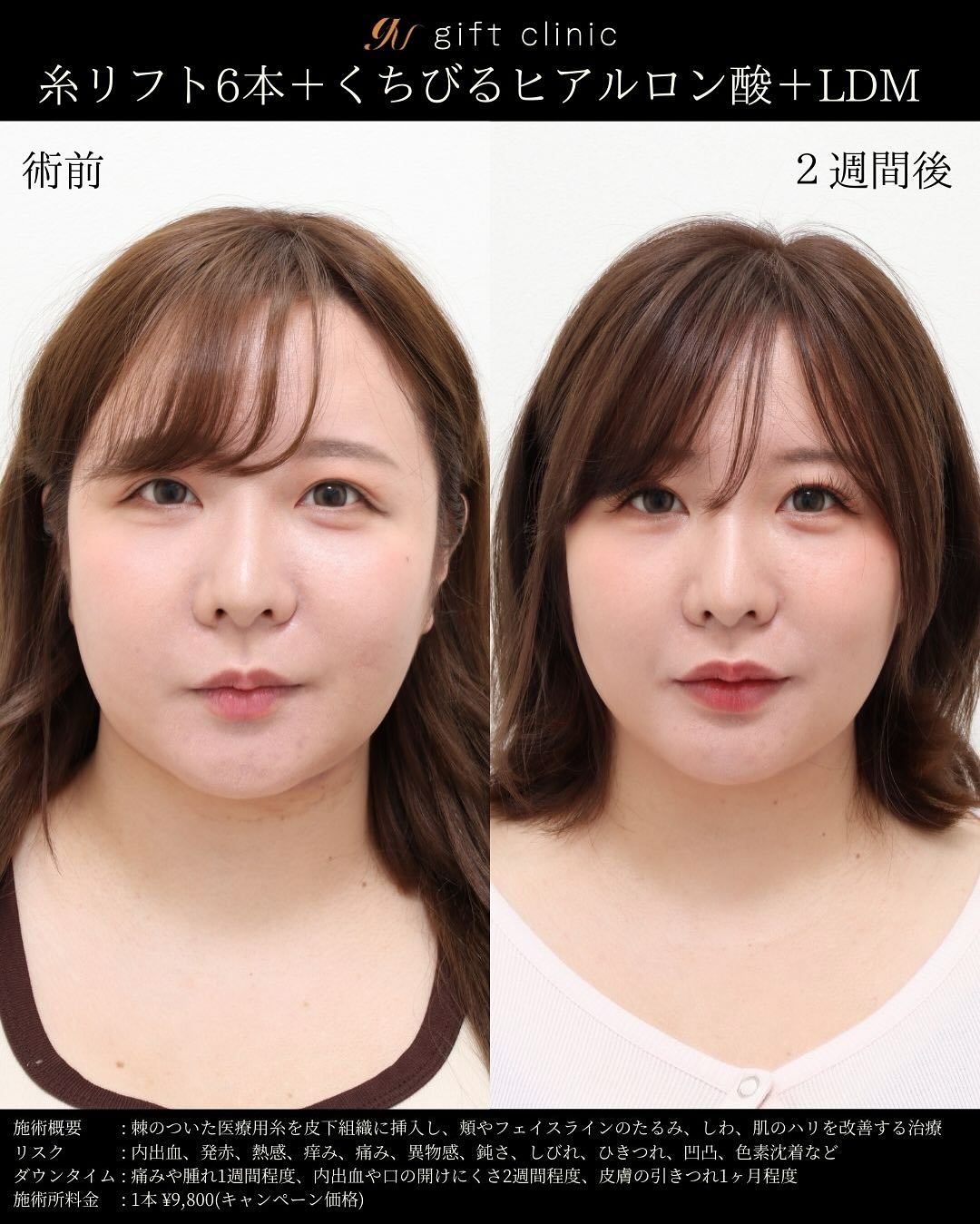 糸リフト6本とくちびるのヒアルロン酸・術前と2週間後｜gift clinic 銀座の糸リフト症例写真