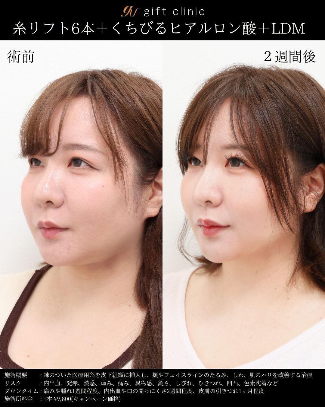 糸リフト6本とくちびるのヒアルロン酸・術前と2週間後｜gift clinic 銀座の糸リフト症例写真