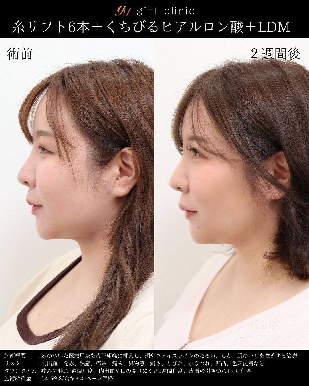 糸リフト6本とくちびるのヒアルロン酸・術前と2週間後｜gift clinic 銀座の糸リフト症例写真