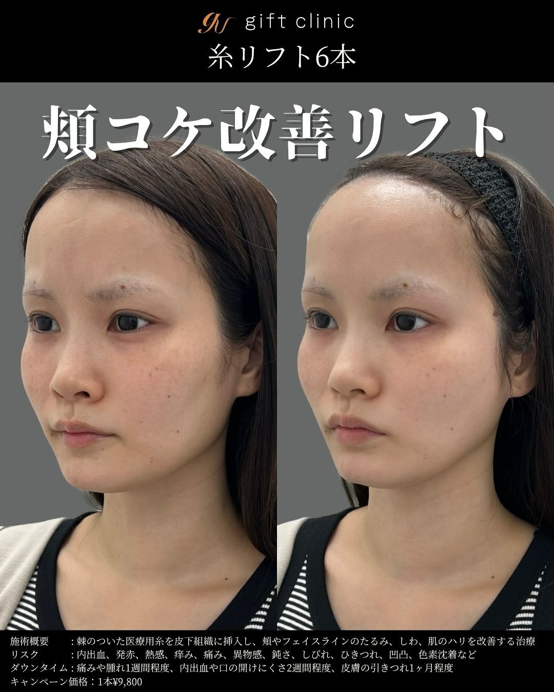 糸リフト6本・術前と術直後｜gift clinic 銀座の糸リフト症例写真