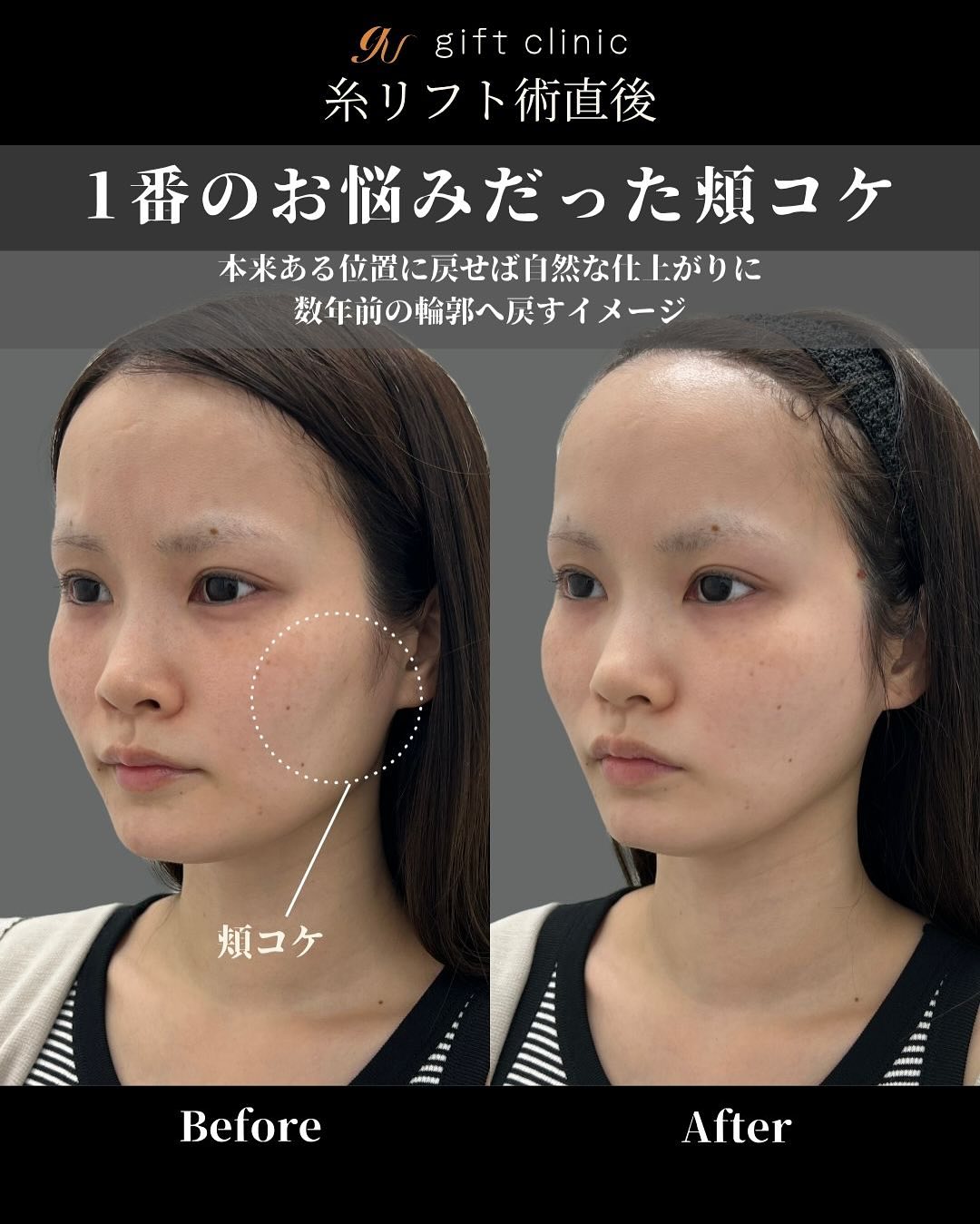 糸リフト6本・術前と術直後｜gift clinic 銀座の糸リフト症例写真