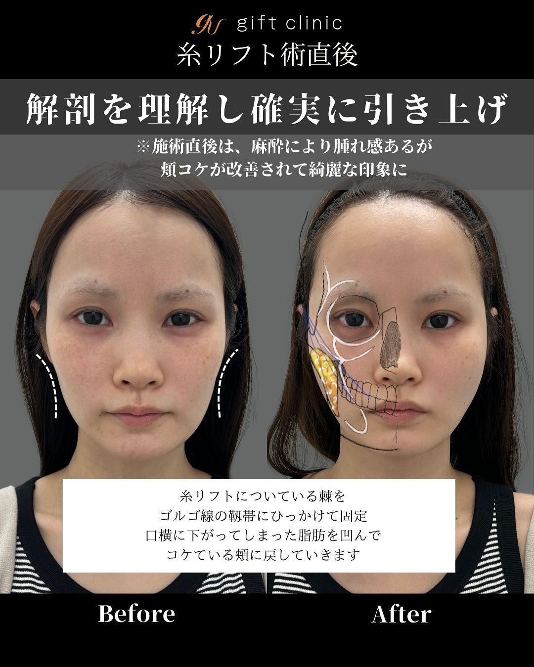 糸リフト6本・術前と術直後｜gift clinic 銀座の糸リフト症例写真