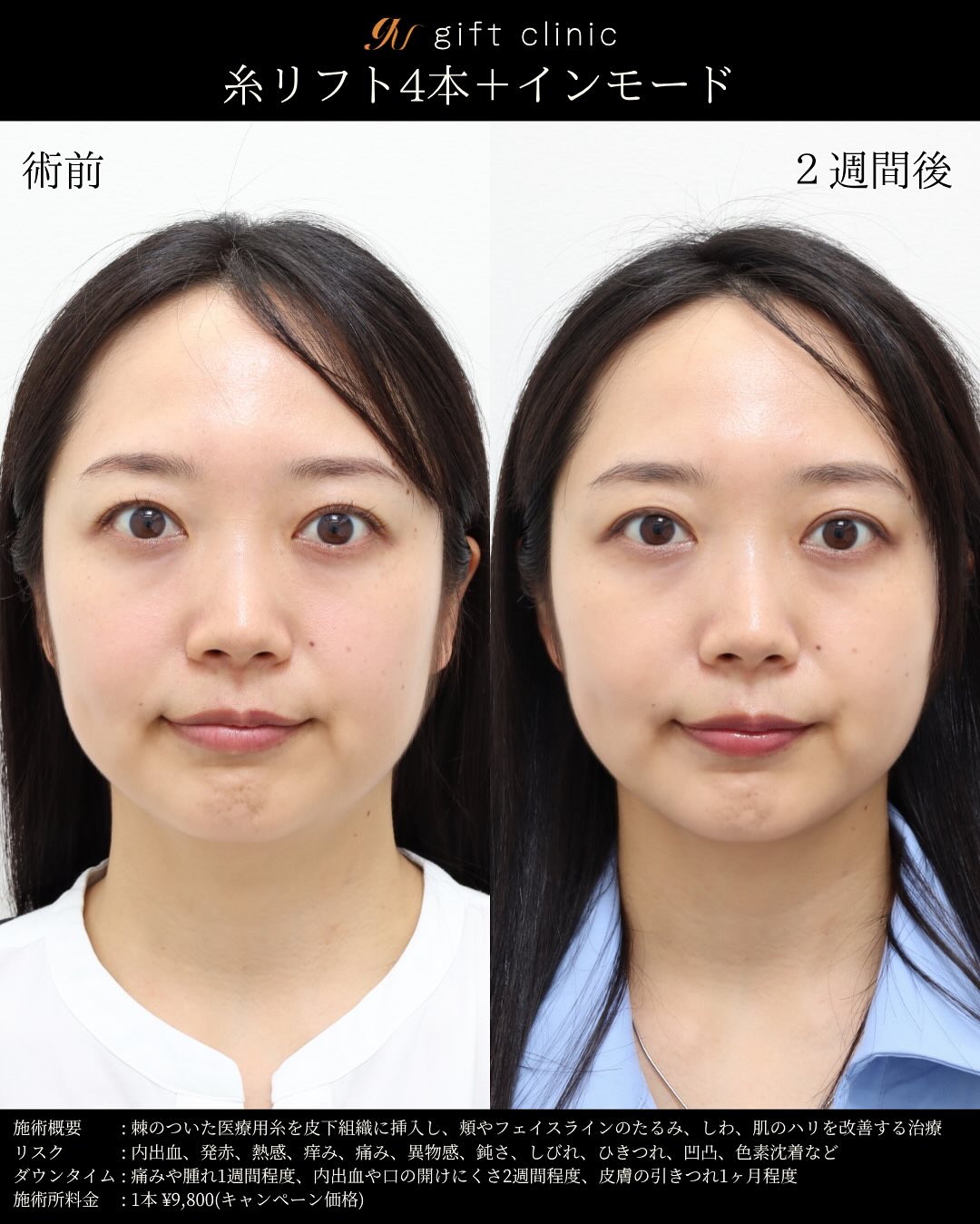 糸リフト4本とインモード・術前と2週間後｜gift clinic 銀座の糸リフト症例写真