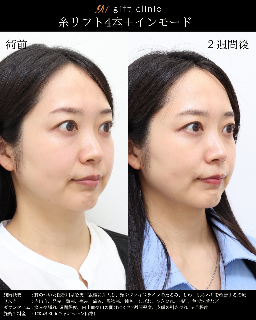 糸リフト4本とインモード・術前と2週間後｜gift clinic 銀座の糸リフト症例写真