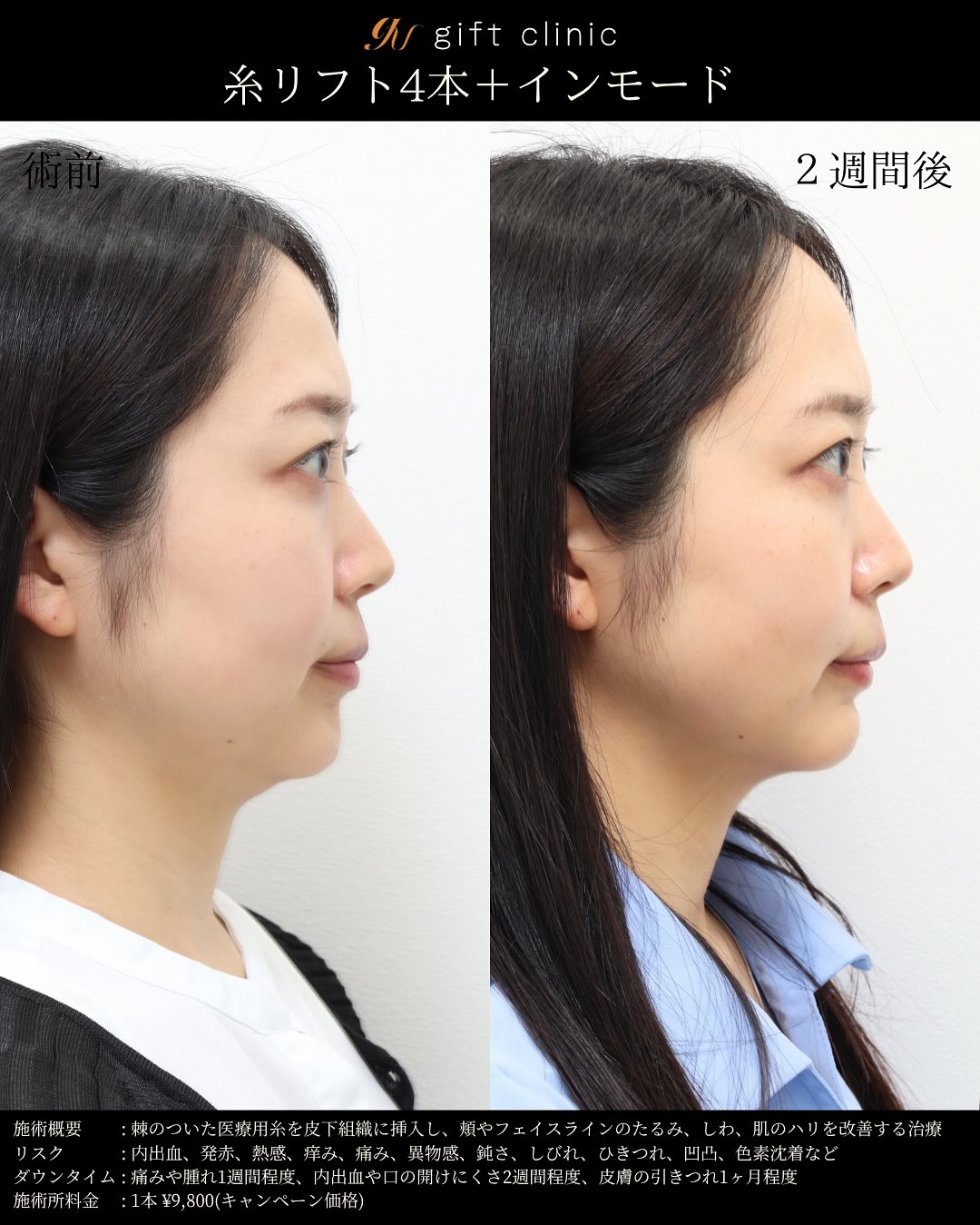 糸リフト4本とインモード・術前と2週間後｜gift clinic 銀座の糸リフト症例写真