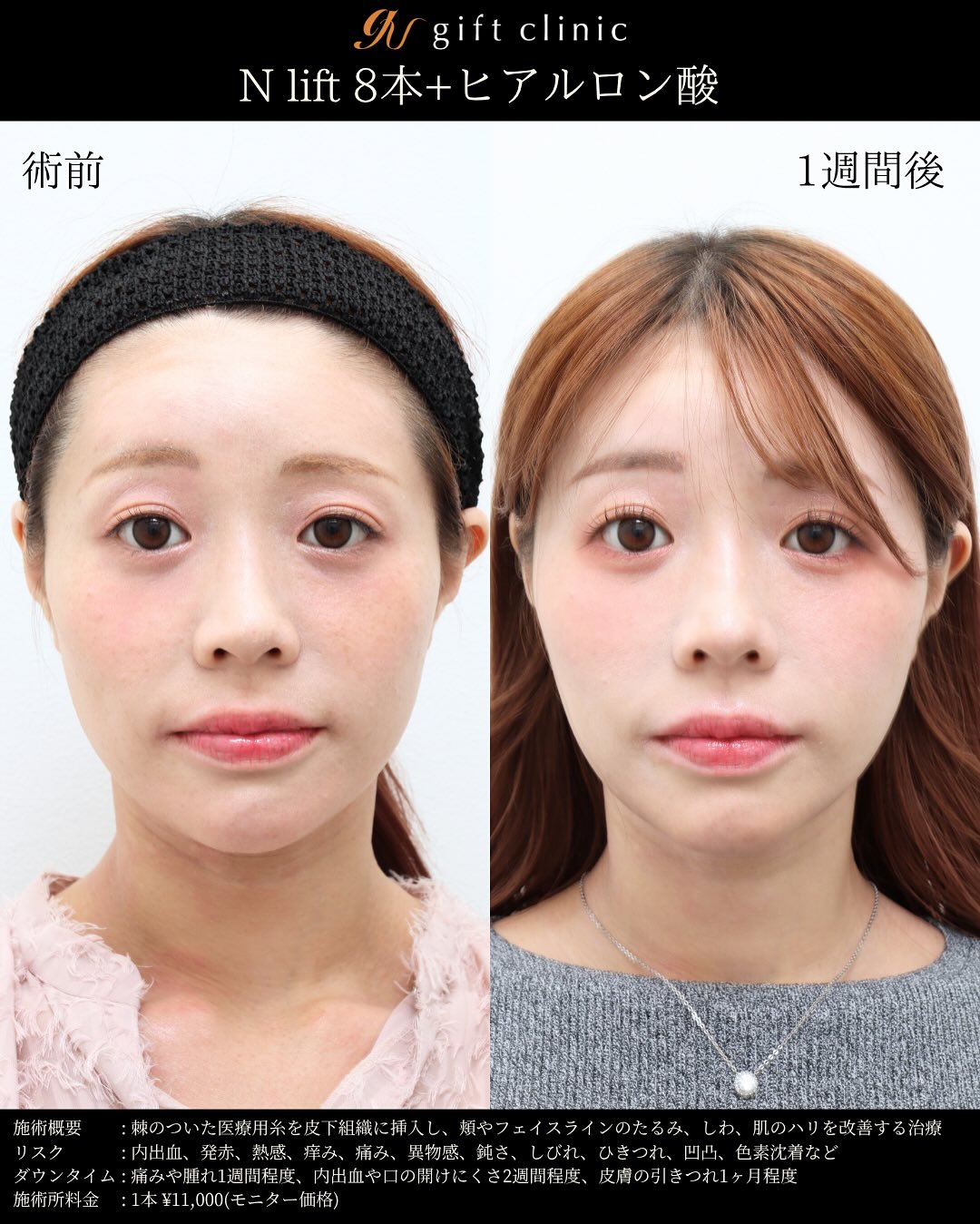 Nリフト8本とヒアルロン酸・術前と1週間後｜gift clinic 銀座の糸リフト症例写真