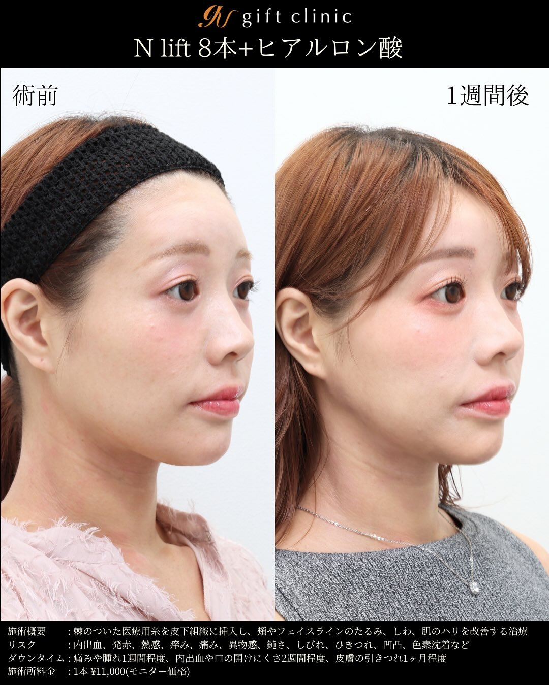 Nリフト8本とヒアルロン酸・術前と1週間後｜gift clinic 銀座の糸リフト症例写真