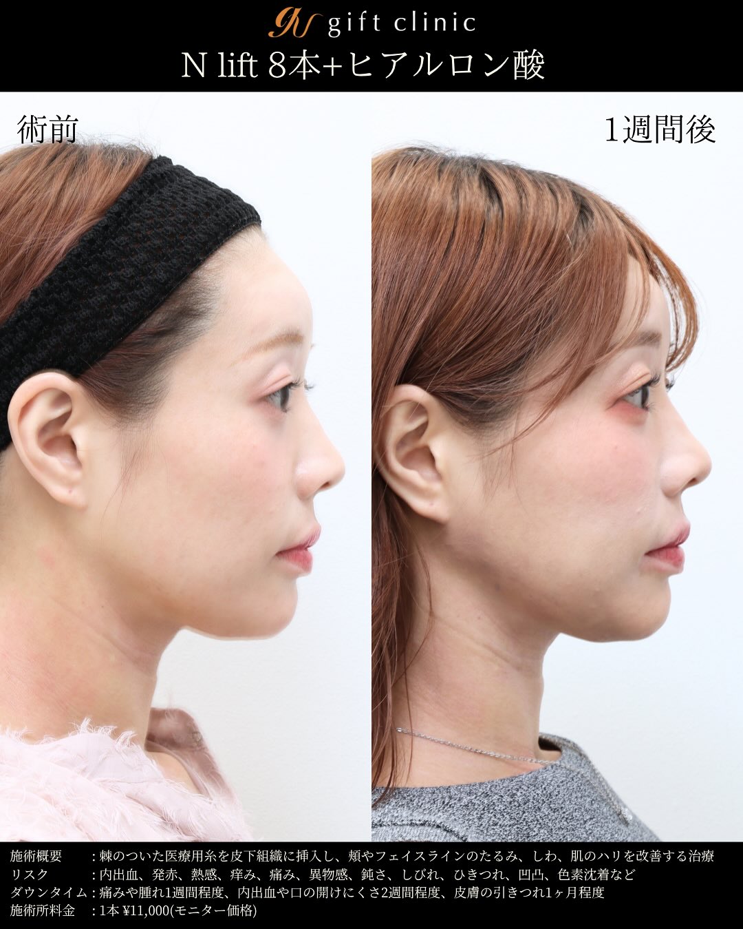 Nリフト8本とヒアルロン酸・術前と1週間後｜gift clinic 銀座の糸リフト症例写真