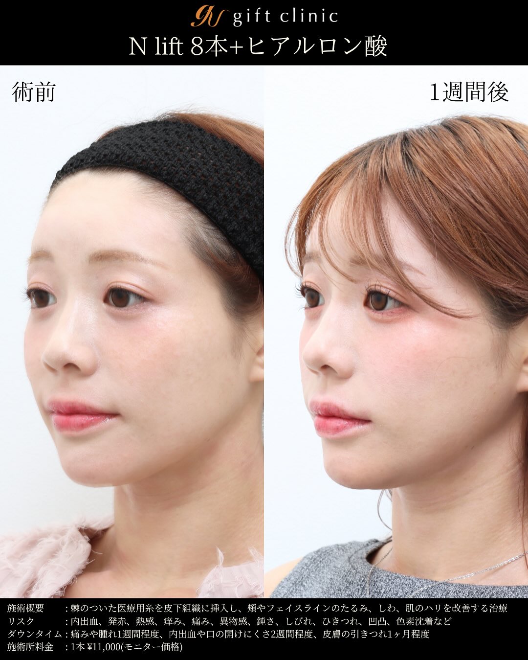 Nリフト8本とヒアルロン酸・術前と1週間後｜gift clinic 銀座の糸リフト症例写真