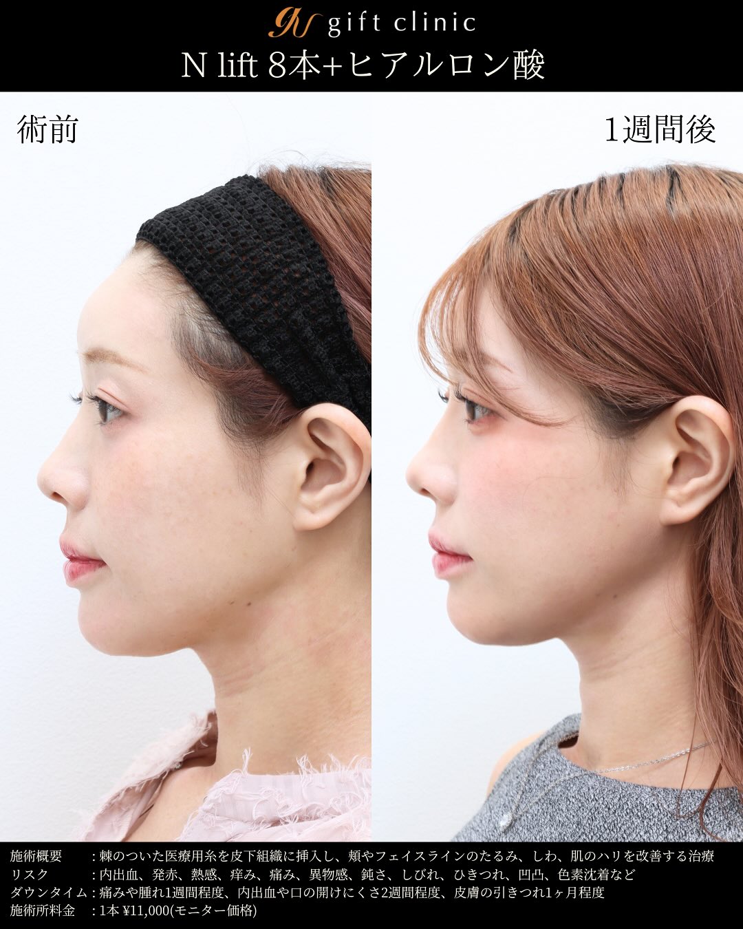 Nリフト8本とヒアルロン酸・術前と1週間後｜gift clinic 銀座の糸リフト症例写真