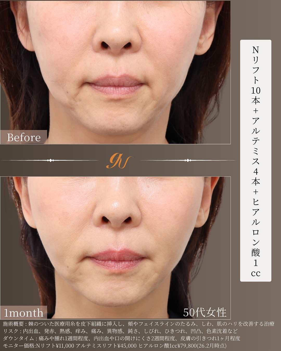 50代・Nリフト10本とヴィーナスリフト4本、ヒアルロン酸・術前と1ヶ月後｜gift clinic 銀座の糸リフト症例写真