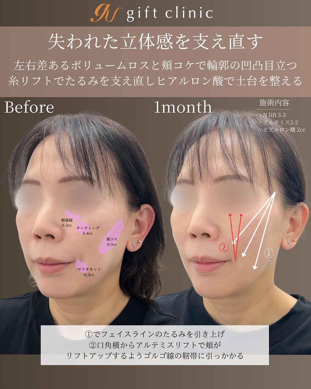 50代・Nリフトを左右3本ずつとヴィーナスリフトを左右2本ずつ、ヒアルロン酸・術前と1ヶ月後｜gift clinic 銀座の糸リフト症例写真