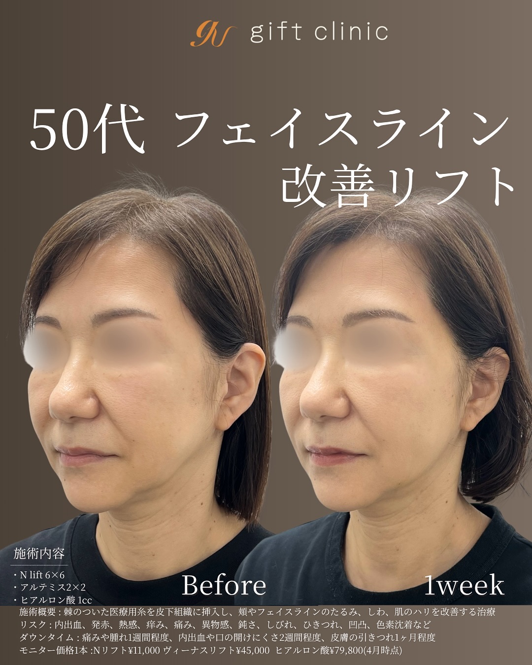 50代・Nリフトを左右6本ずつとヴィーナスリフトを左右2本ずつ、ヒアルロン酸・術前と1週間後｜gift clinic 銀座の糸リフト症例写真
