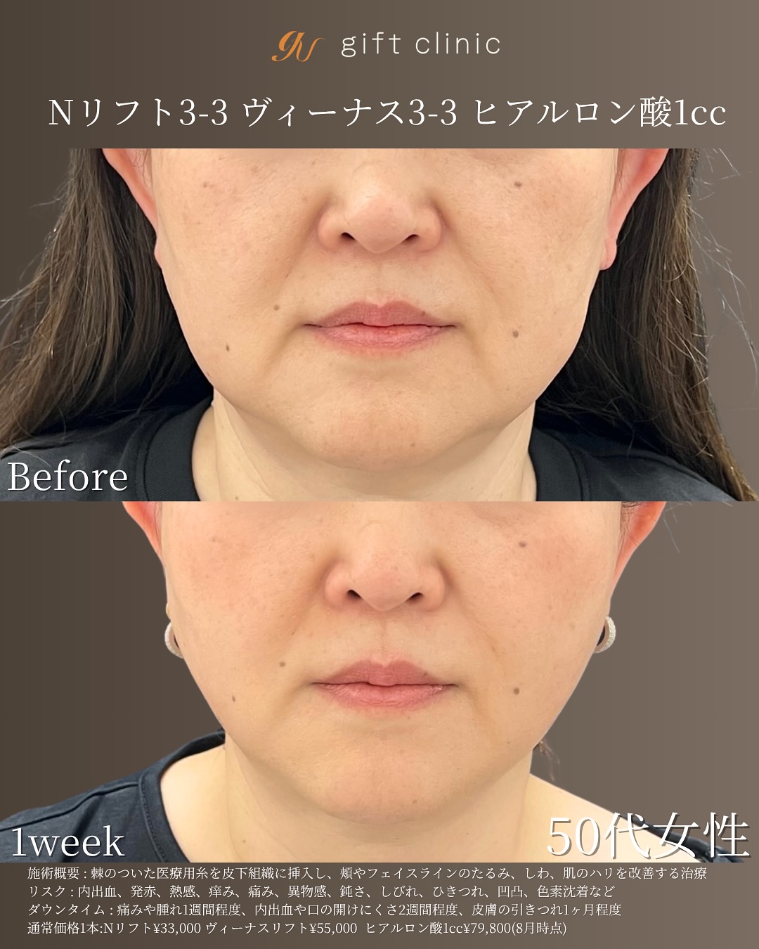 50代・Nリフトを左右3本ずつとヴィーナスリフトを左右3本ずつ、ヒアルロン酸・術前と1週間後｜gift clinic 銀座の糸リフト症例写真