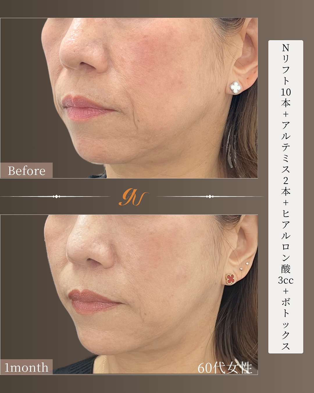 60代・Nリフト10本とヴィーナスリフト2本、ヒアルロン酸とボトックス・術前と1ヶ月後｜gift clinic 銀座の糸リフト症例写真