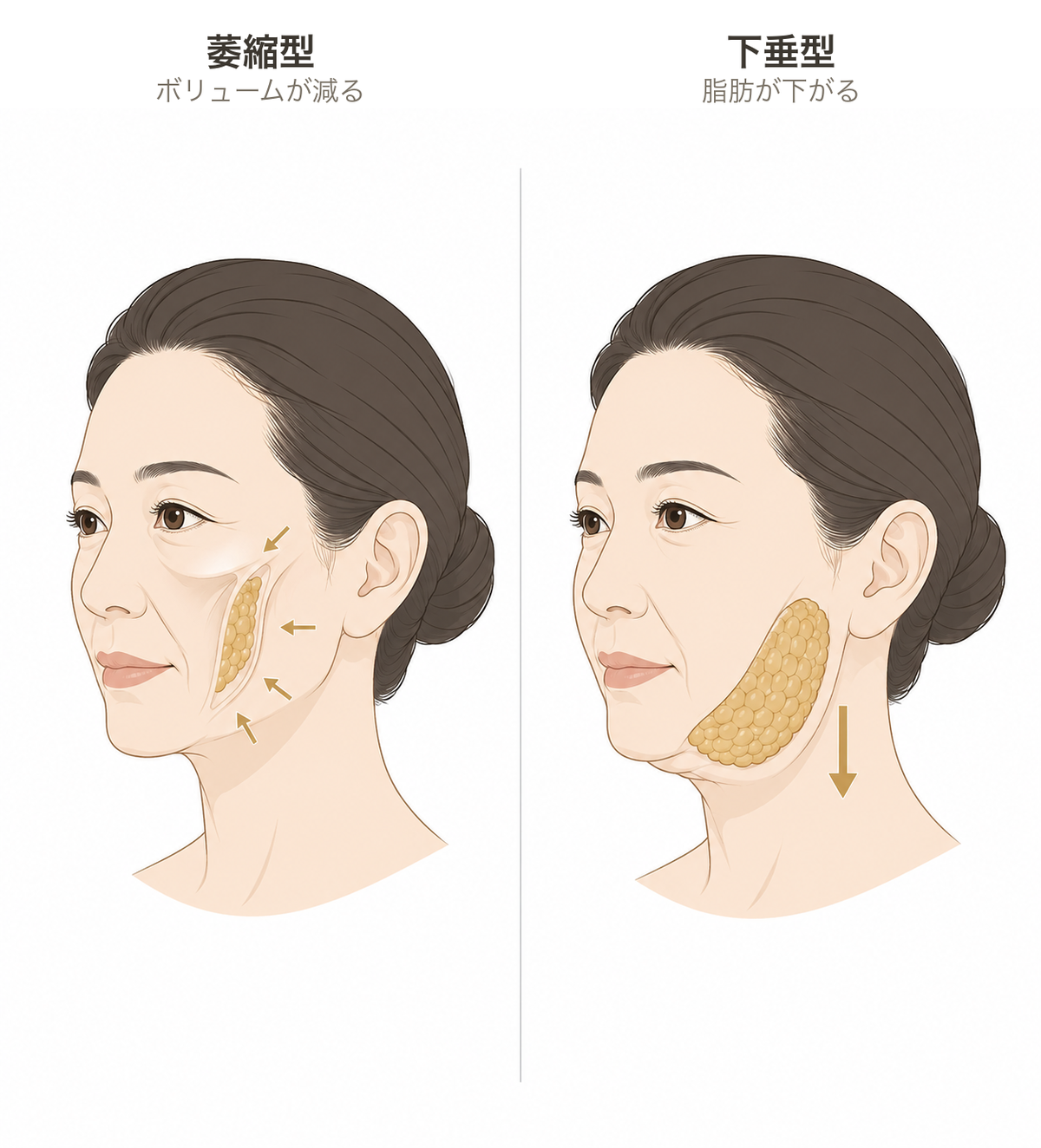 頬のたるみの萎縮型と下垂型の違いを示した図